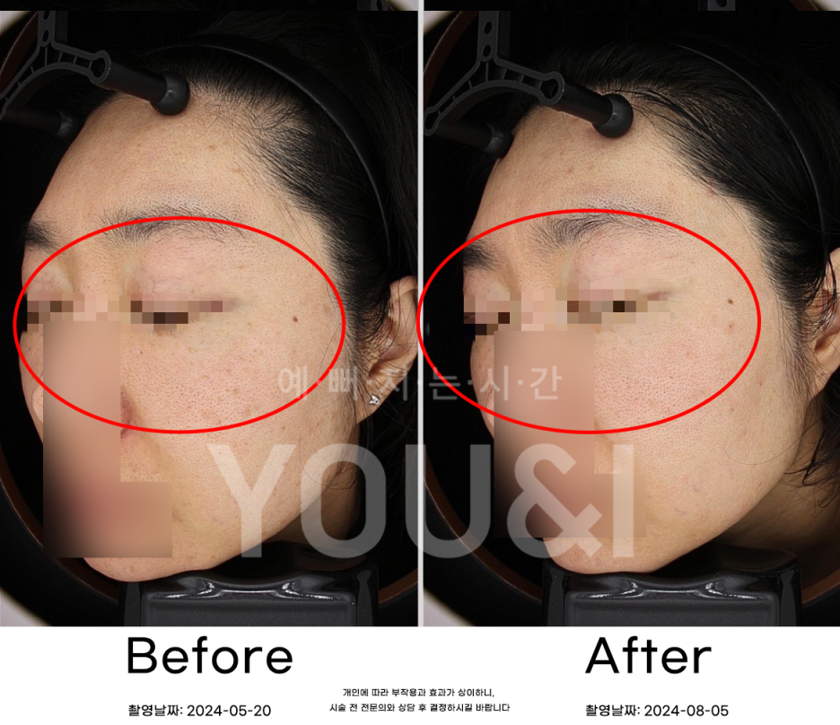 왕십리 잡티제거 레이저로 깨끗하게 <실제 시술 후기> 관련 이미지 4