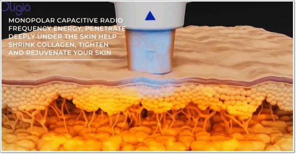 왕십리피부과 탄력 개선 리프팅, 신중해야 하는 이유는? 관련 이미지 6