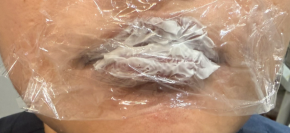 왕십리입술필러? 비대칭 개선한 실제 케이스 보여드립니다 관련 이미지 5