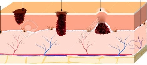 성동구 점빼기 피부과 흉터를 피하려면 확인하세요 관련 이미지 6