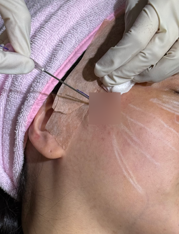 코그실리프팅, 대표원장이 직접 시술받아 봤습니다 관련 이미지 9