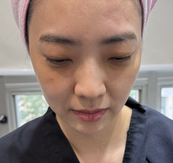 코그실리프팅, 대표원장이 직접 시술받아 봤습니다 관련 이미지 5