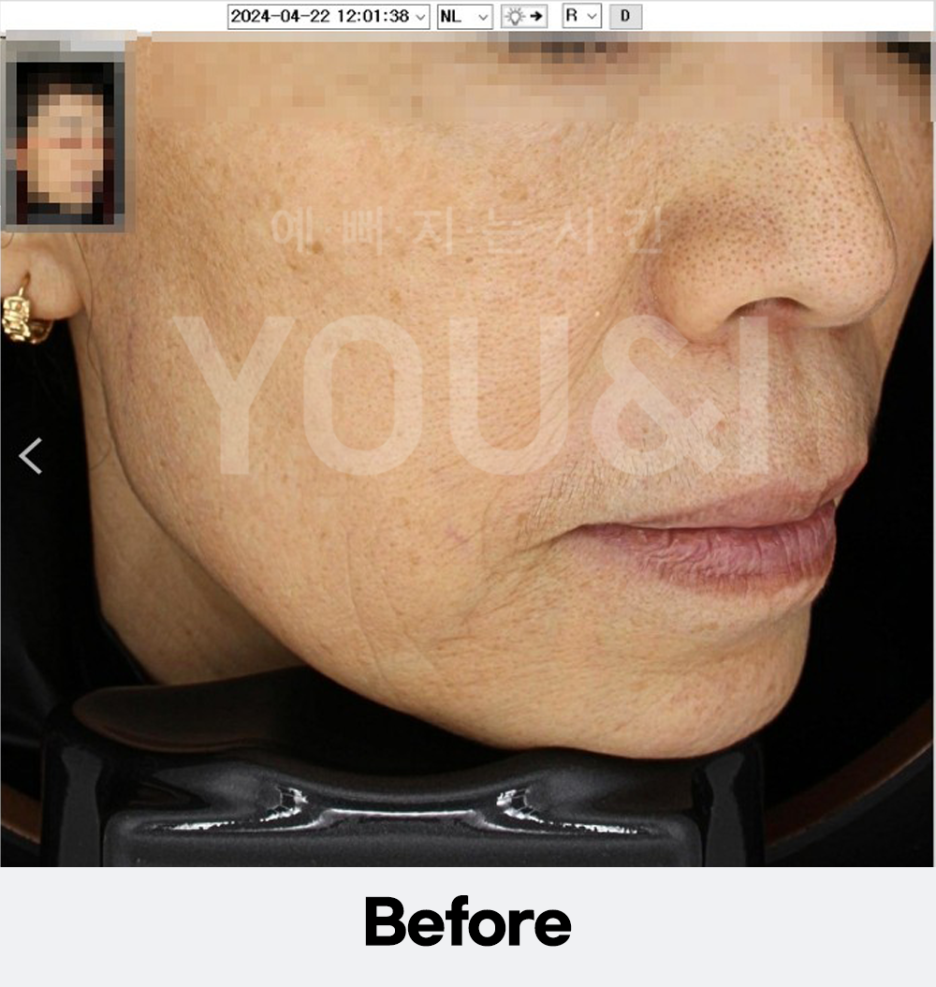 왕십리 리프팅, 올리지오 팔자주름 개선 시술 후기 관련 이미지 2