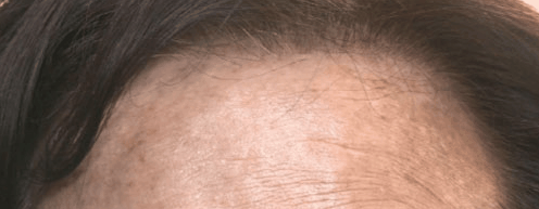 성동구 왕십리 목 릴흑피증(릴흑색증) 실제 치료 사례 관련 이미지 2