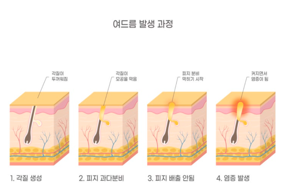 왕십리여드름? 전문의가 알려드립니다 관련 이미지 5