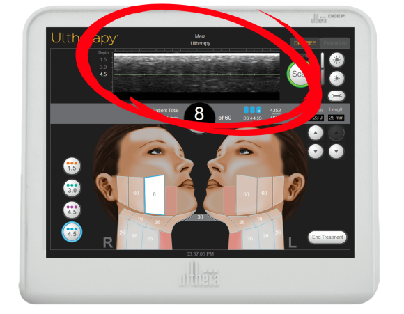 왕십리 슈링크, 울쎄라와 고민된다면 <필독> 관련 이미지 3
