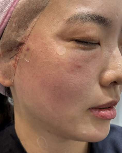 코그실리프팅, 대표원장이 직접 시술받아 봤습니다 관련 이미지 11