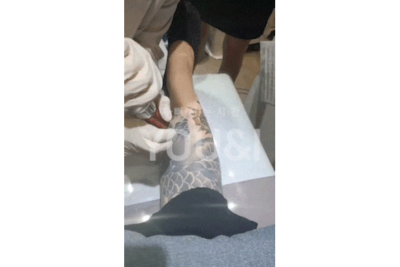 성동구 문신제거 잘하는 곳? 실제 치료 후기 관련 이미지 6