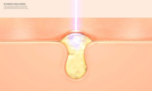 왕십리여드름피부과, 근본부터 해결해야 합니다 관련 이미지 2