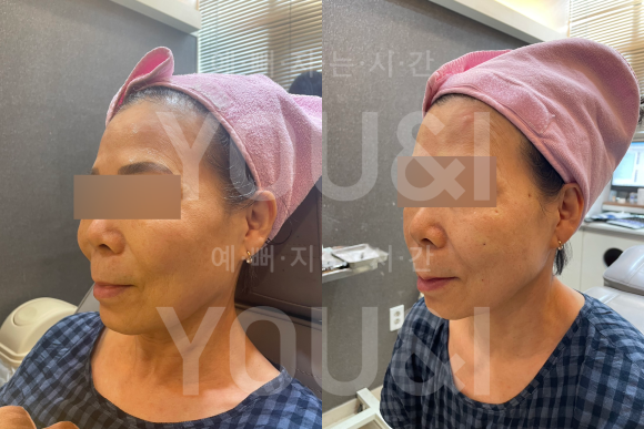 성동구 왕십리 실리프팅 팔자주름 개선 사례 <실제 후기> 관련 이미지 6