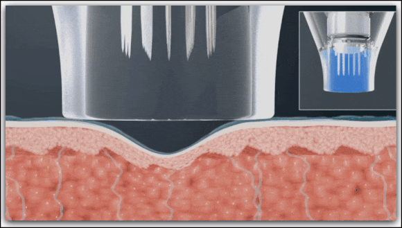 포텐자리프팅? 피부과 전문의 대표원장이 정리 해드립니다 관련 이미지 3