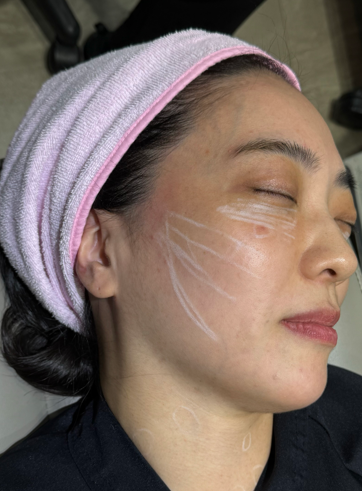 코그실리프팅, 대표원장이 직접 시술받아 봤습니다 관련 이미지 6