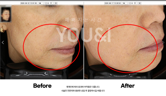 왕십리 리프팅, 올리지오 팔자주름 개선 시술 후기 관련 이미지 6
