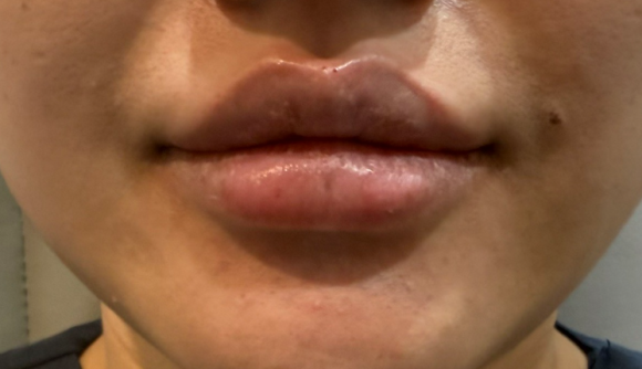 왕십리입술필러? 비대칭 개선한 실제 케이스 보여드립니다 관련 이미지 10