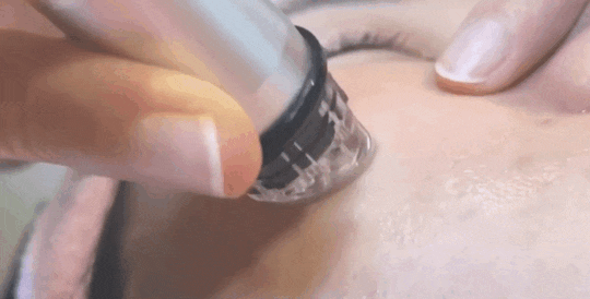 왕십리아쿠아필, 블랙헤드가 고민이라면? 관련 이미지 4