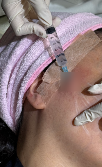 코그실리프팅, 대표원장이 직접 시술받아 봤습니다 관련 이미지 8