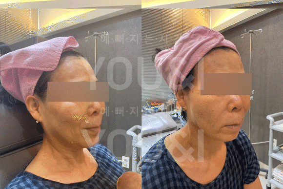 성동구 왕십리 실리프팅 팔자주름 개선 사례 <실제 후기> 관련 이미지 4
