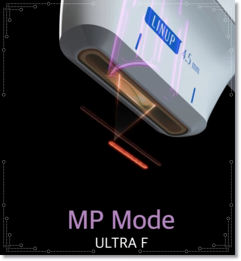 슈링크올리지오차이, 어떤 시술이 적합할지 궁금하다면? 관련 이미지 6