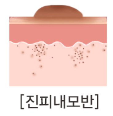 왕십리점제거 피부과 알아보신다면 관련 이미지 5