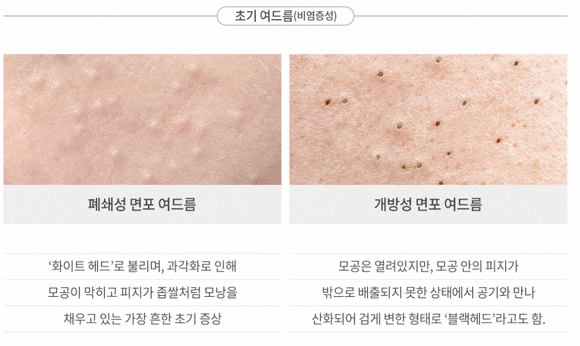 왕십리여드름, 어떻게 해결할 수 있을까요? 관련 이미지 3