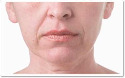 왕십리피부과 탄력 개선 리프팅, 신중해야 하는 이유는? 관련 이미지 9