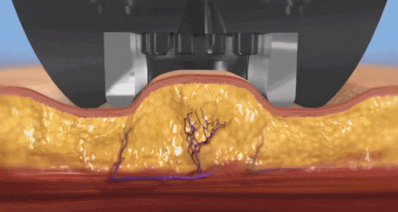 성동구 인모드리프팅, 브이라인을 원하신다면 관련 이미지 3