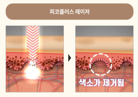 왕십리 기미제거 잡티제거, 효과 못 봤다면 관련 이미지 6