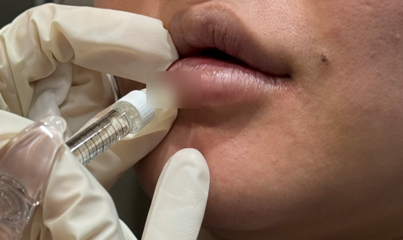 왕십리입술필러? 비대칭 개선한 실제 케이스 보여드립니다 관련 이미지 8