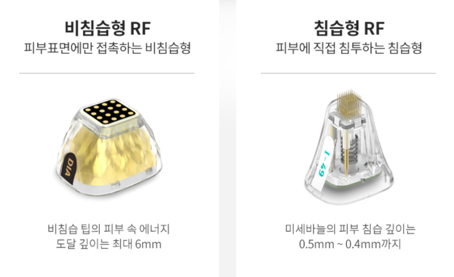 왕십리포텐자? 다재다능한 시술 찾는다면 <필독> 관련 이미지 5