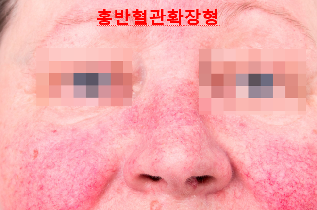 주사피부염 (민감성피부, 안면홍조) 원인, 유형, 악화요인 (1) 관련 이미지 3