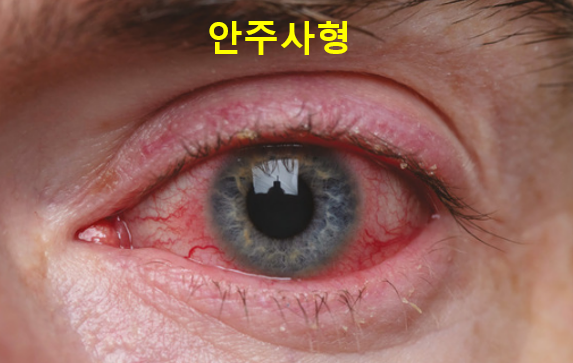 주사피부염 (민감성피부, 안면홍조) 원인, 유형, 악화요인 (1) 관련 이미지 6