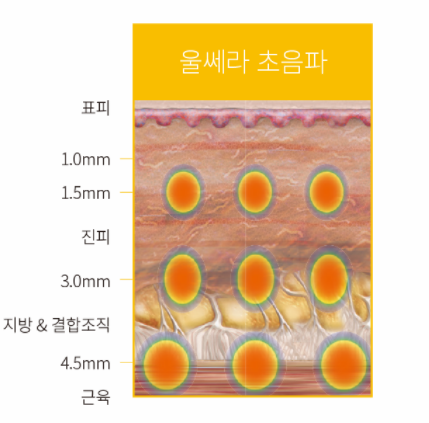 [동대문피부과]리프팅, 탄력 치료의 모든것 1(feat. 울쎄라, 인모드, 써마지) 관련 이미지 1