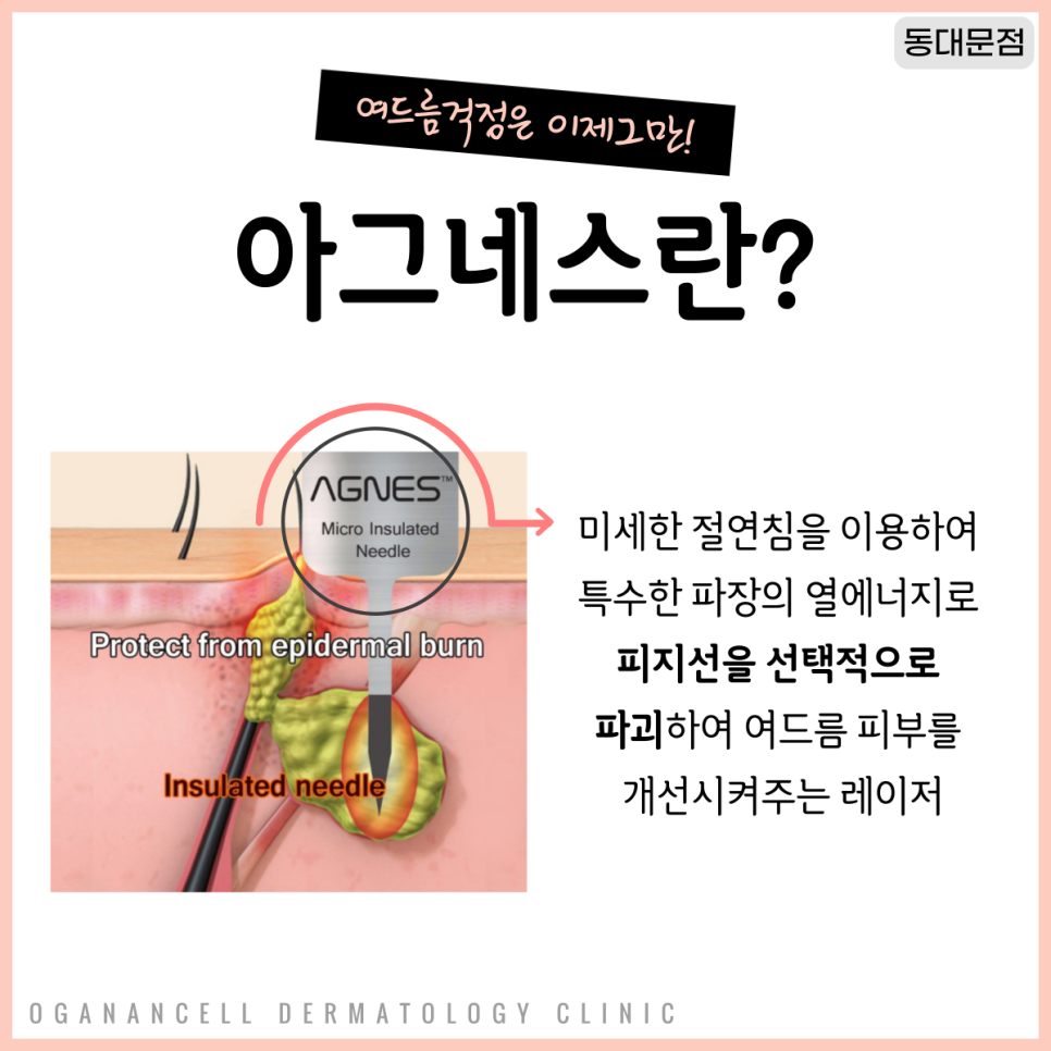 [청량리피부과] 반복되는 여드름이 고민이라면? 아그네스로 치료하자! 관련 이미지 2