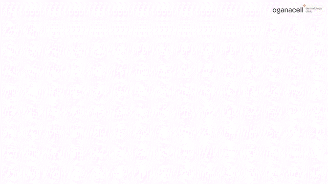 튼살큐어젯 고민을 해결하는 관련 이미지 31