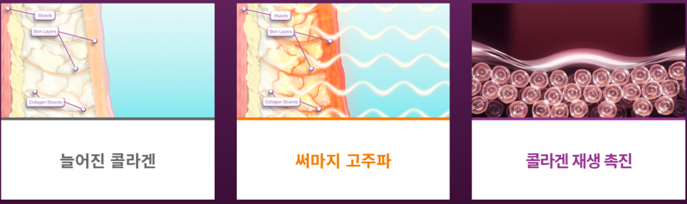 [동대문피부과]리프팅, 탄력 치료의 모든것 2(feat. 울쎄라, 인모드, 써마지) 관련 이미지 2