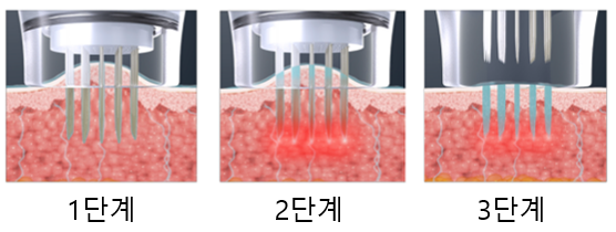 콜라겐 부스터 쥬베룩에 대한 모든것 관련 이미지 12