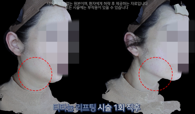 얼굴이 착 달라붙는 핫한 티타늄 리프팅 관련 이미지 4