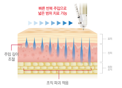 흉터 치료의 새로운 패러다임 (feat. 큐어젯) 관련 이미지 5