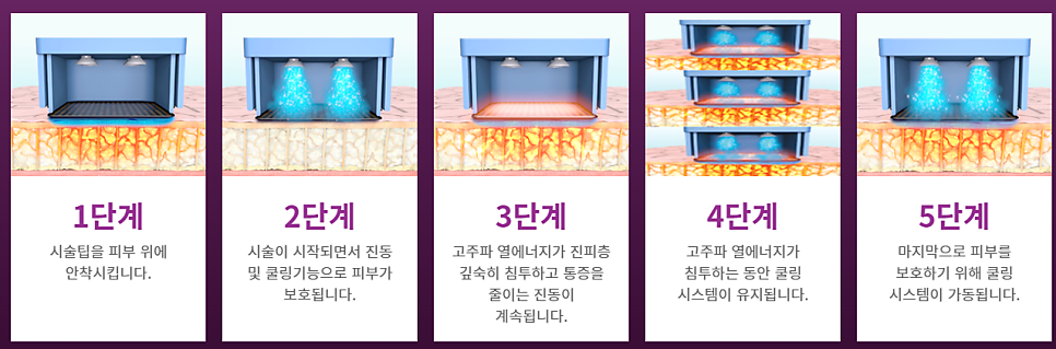 [동대문피부과]리프팅, 탄력 치료의 모든것 2(feat. 울쎄라, 인모드, 써마지) 관련 이미지 3