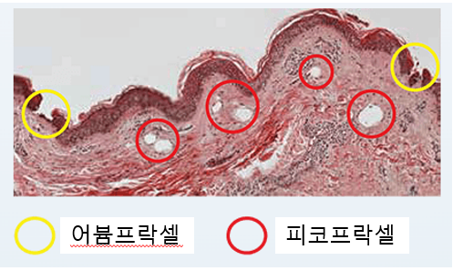 [동대문피부과] 모공, 좋아질수 있습니다! 관련 이미지 3