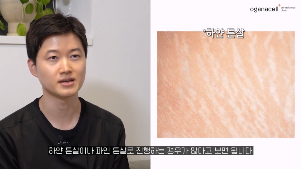 튼살큐어젯 고민을 해결하는 관련 이미지 14