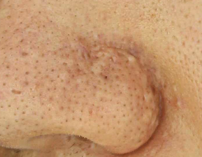 여드름흉터 포기하지 말고 치료할수 있습니다 관련 이미지 4