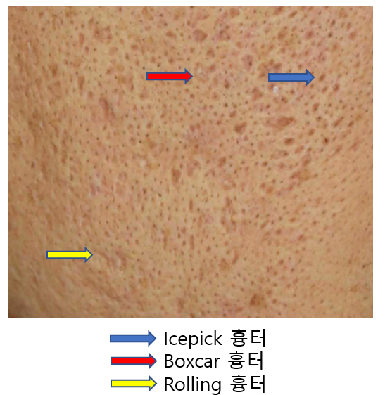 여드름흉터 포기하지 말고 치료할수 있습니다 관련 이미지 8