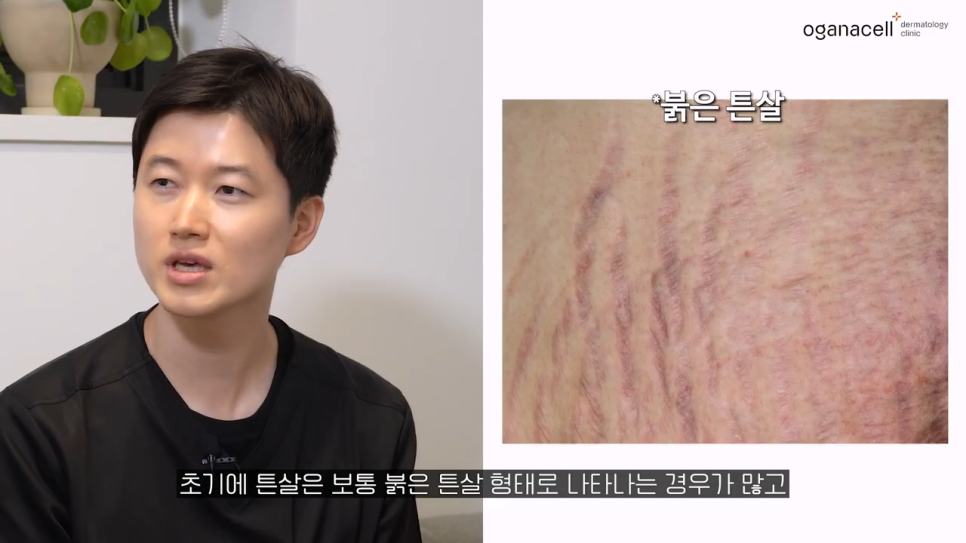 튼살큐어젯 고민을 해결하는 관련 이미지 12