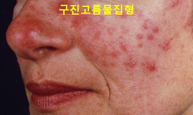 주사피부염 (민감성피부, 안면홍조) 원인, 유형, 악화요인 (1) 관련 이미지 4