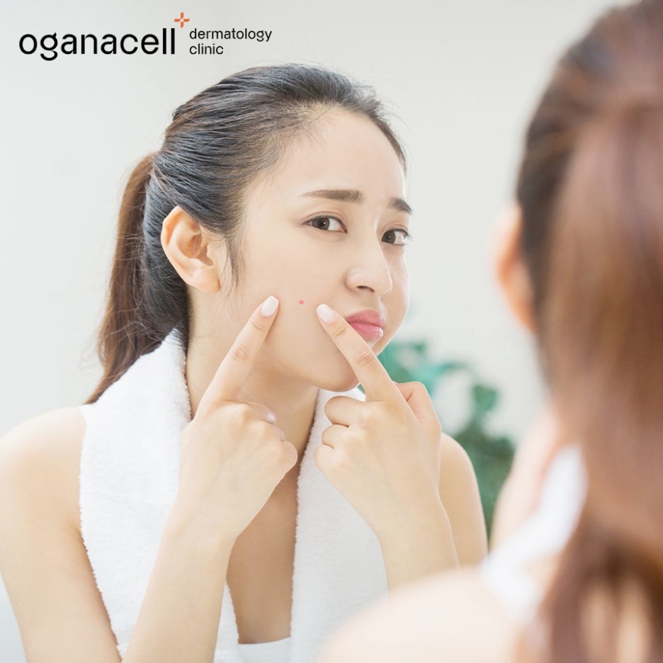 얼굴 부위별 여드름 원인 살펴볼까요 관련 이미지 4