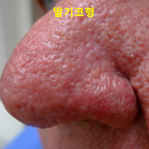주사피부염 (민감성피부, 안면홍조) 원인, 유형, 악화요인 (1) 관련 이미지 5