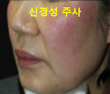 주사피부염 (민감성피부, 안면홍조) 원인, 유형, 악화요인 (1) 관련 이미지 7