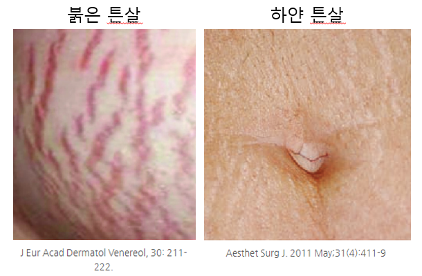 새로운 튼살 치료! 이제 큐어젯으로 해결할 수 있습니다 관련 이미지 1