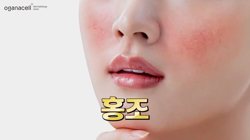동대문홍조치료 유형별 원인을 파악해요 관련 이미지 2